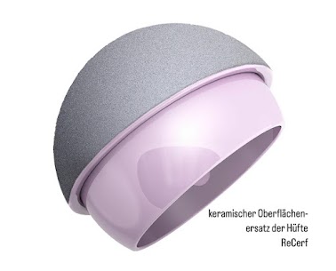 keramischen Oberflächenersatz der Hüfte ReCerf