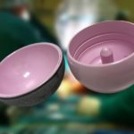 ReCerf Keramischer Oberflächenersatz von Hüftspezialist Dr. Alexander Moser in Berlin